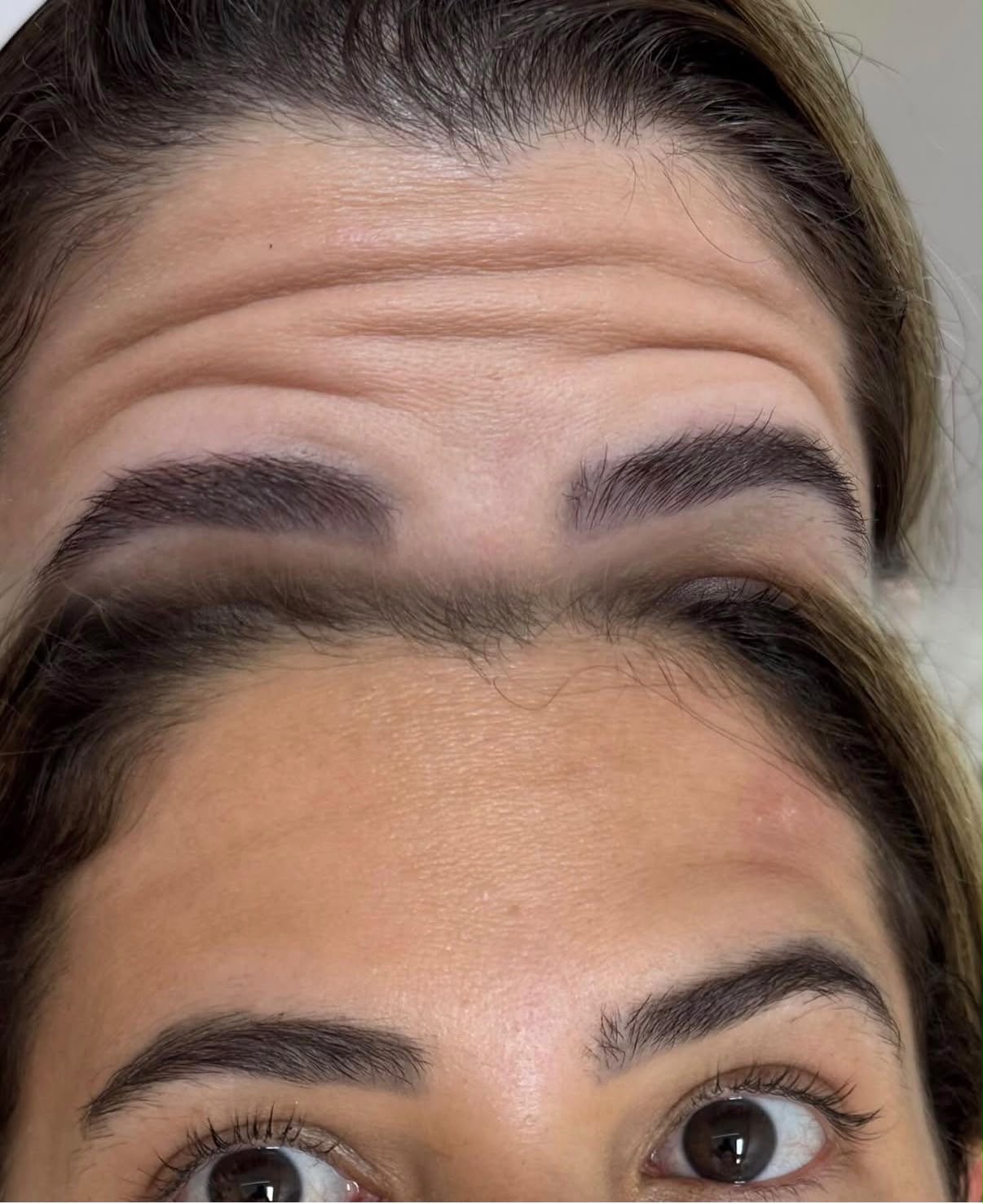 Botox