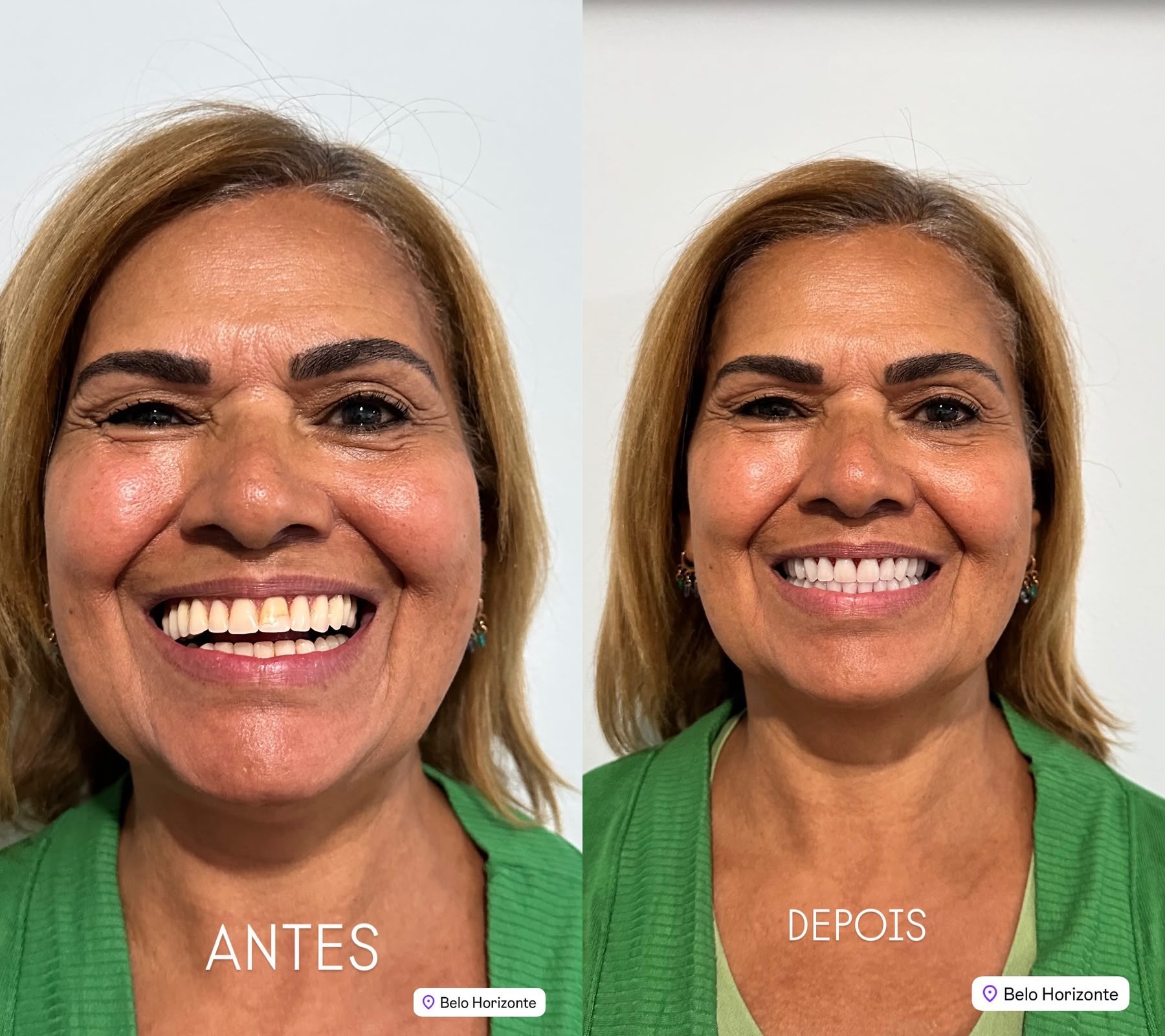 Prótese e estética do sorriso