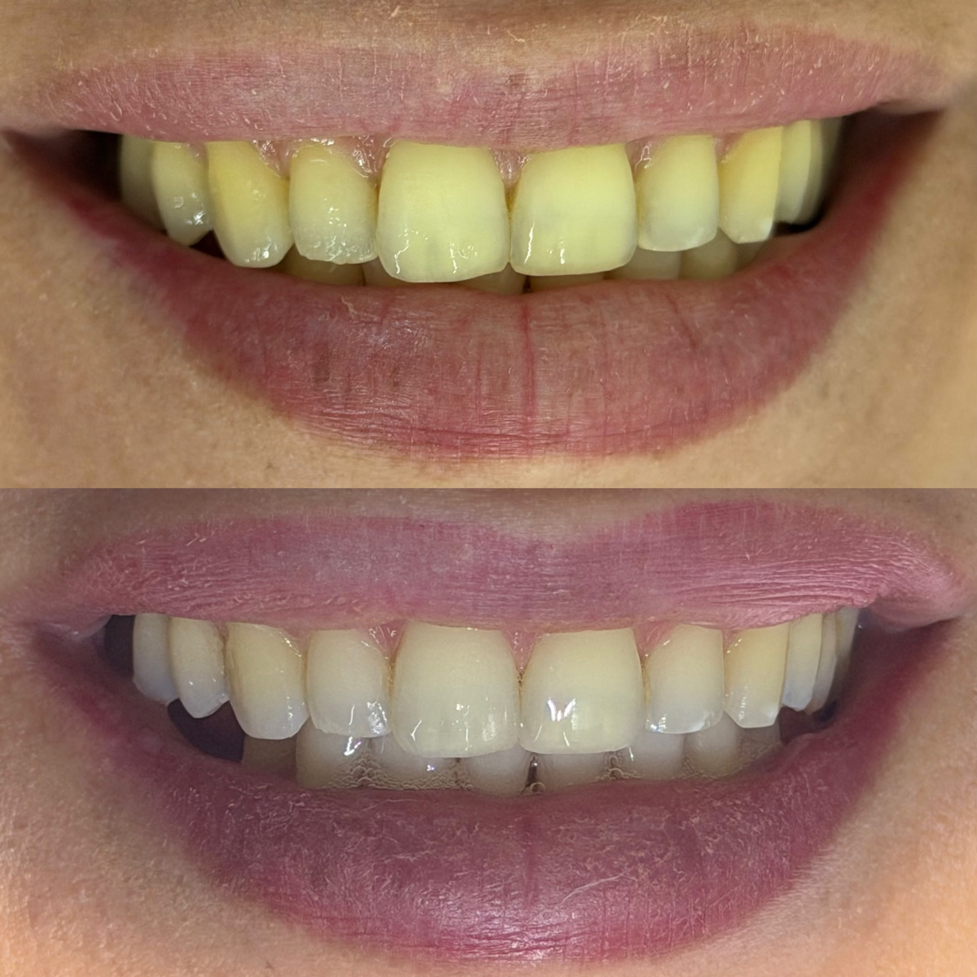 Clareamento dental