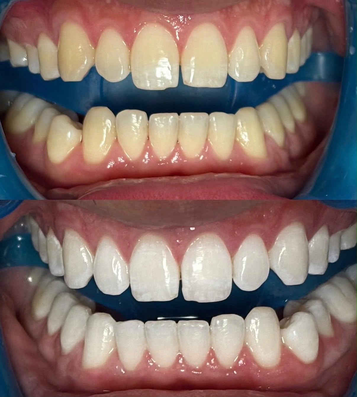 Clareamento Dental