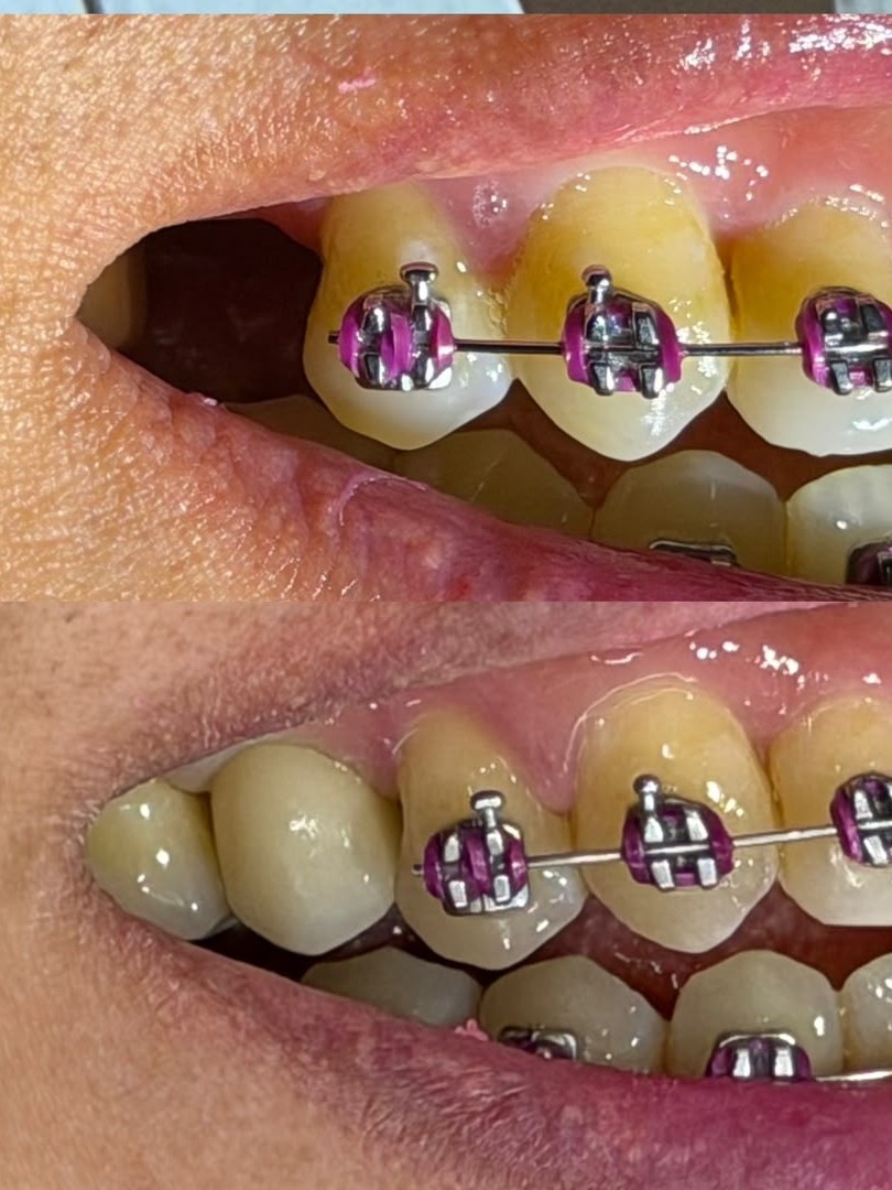 Implante dentário